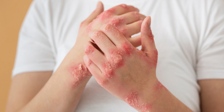 psoriasis-2