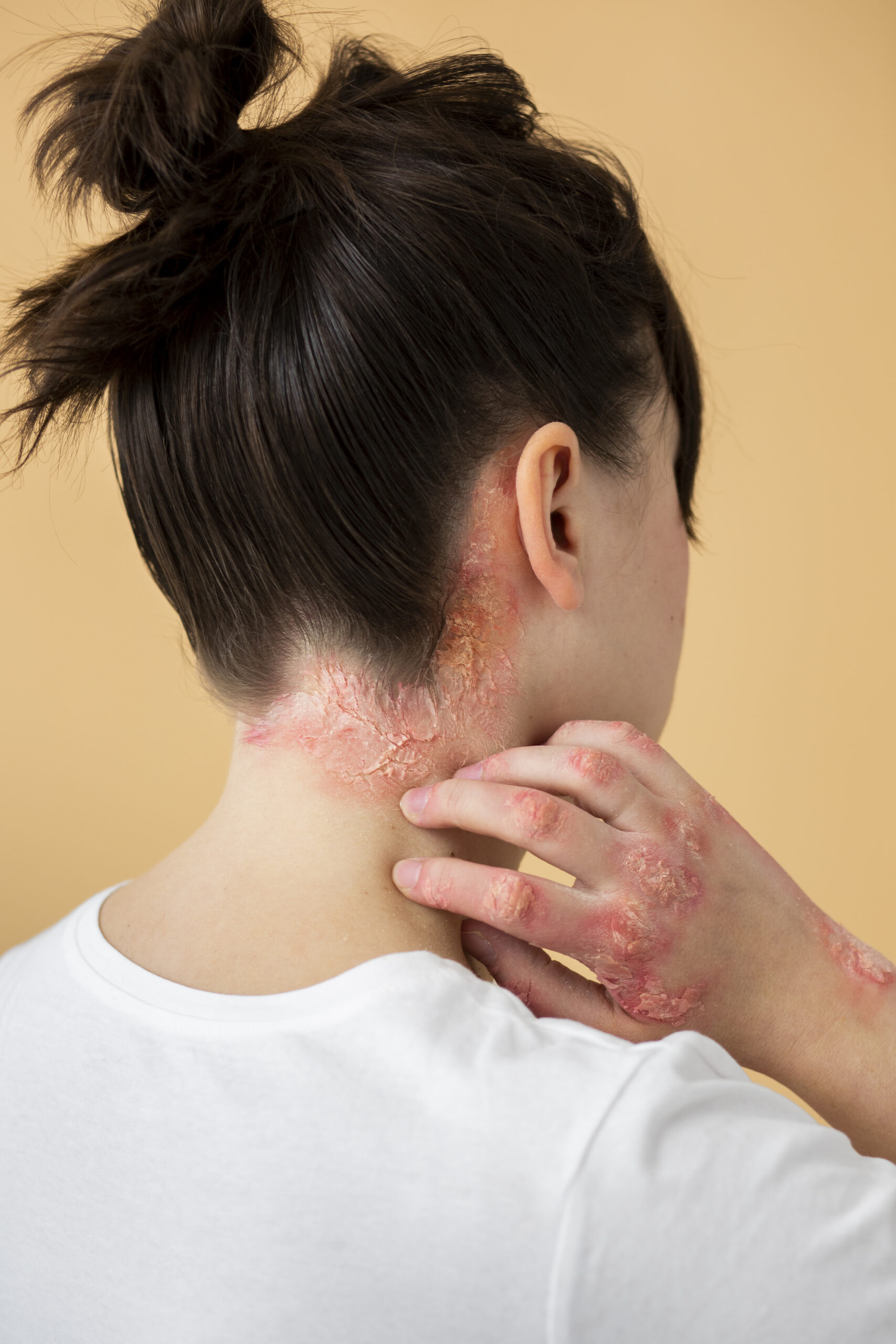 psoriasis-eczema-neck-patient